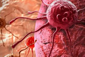 سرطان پروستات در مردان شایع‌ترین نوع سرطان می‌باشد